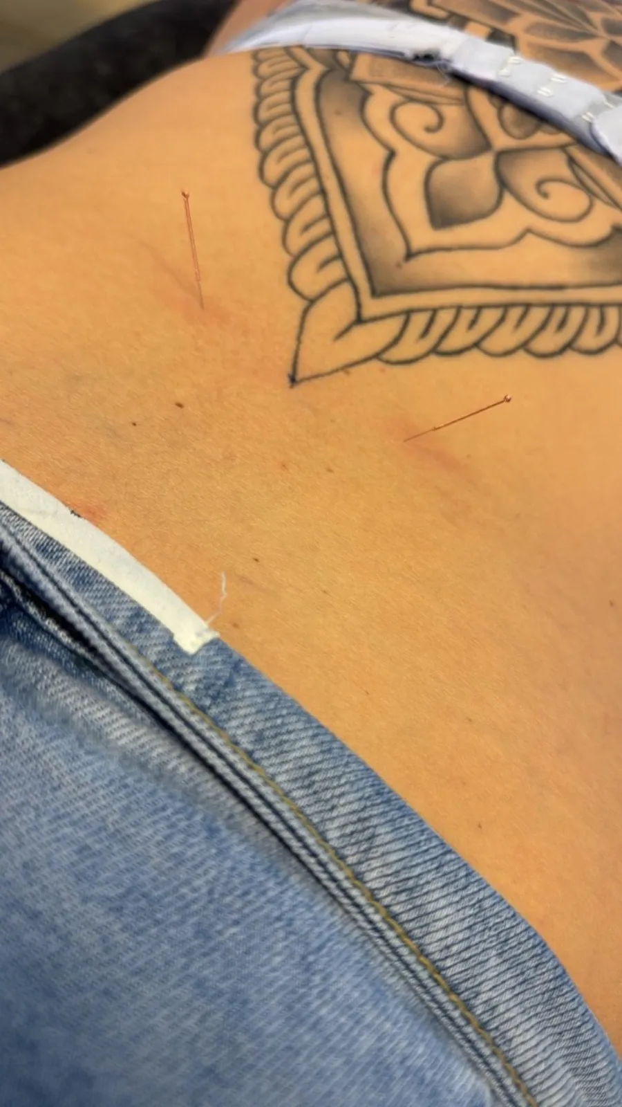 Dry Needling